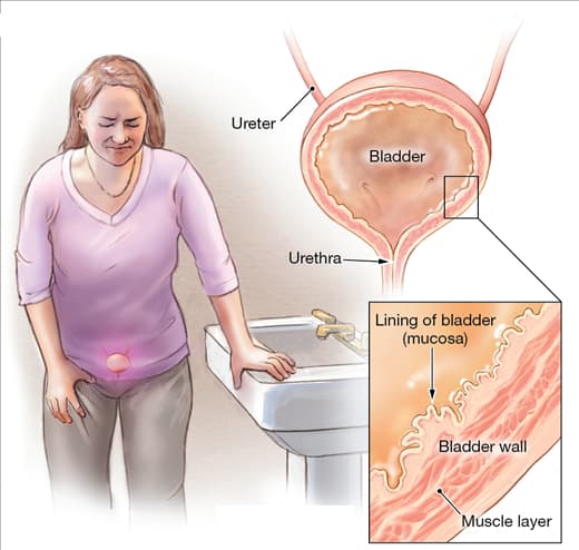 Interstitial Cystitis