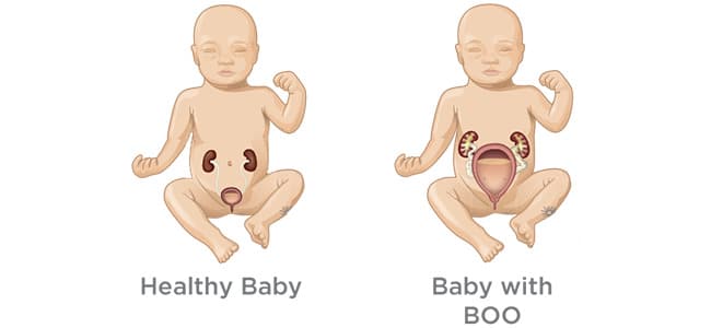 Bladder Outlet / Neck Obstruction (BOO / BNO)