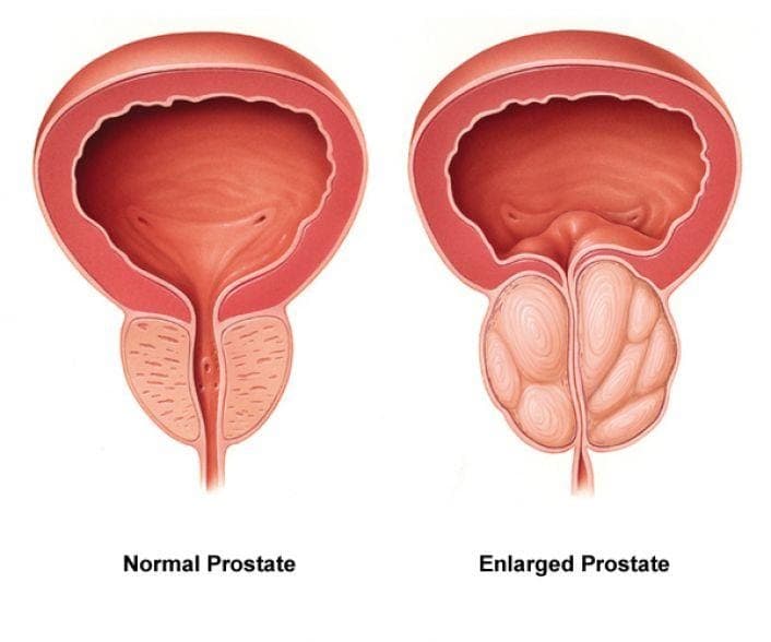 Normal Prostate and Enlarged Prostate
