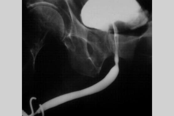 Micturating Cystourethrogram