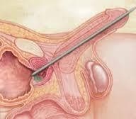 Urethral Dilatation