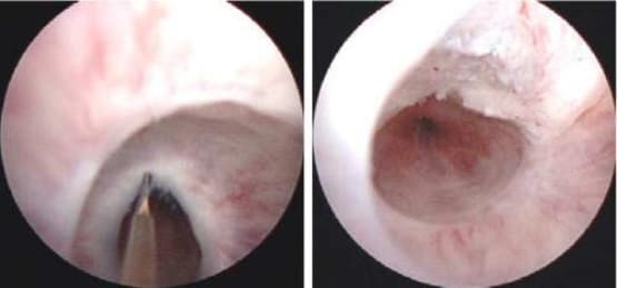 Urethrotomy VIU / DVIU