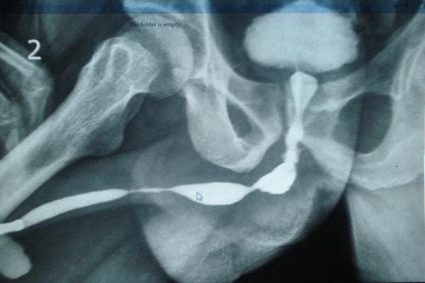 Retrograde Urethrogram 13.1