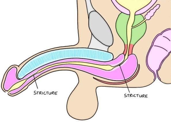Urethral Stricture Image 1.1