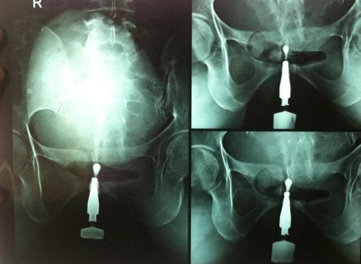 Retrograde Urethrogram 13.2