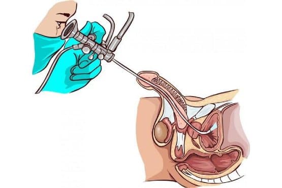Cysto-urethroscopy