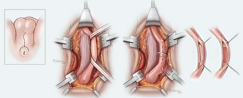 Urethroplasty