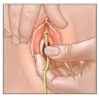 Self Catheterization Female