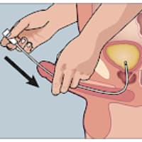 Self Catheterization Male
