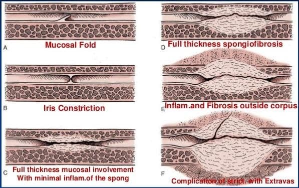 Wound Healing by Granulation