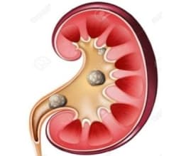 Urinary stones