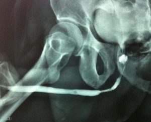 stricture urethral turp bph stenosis bladder incontinence suffer